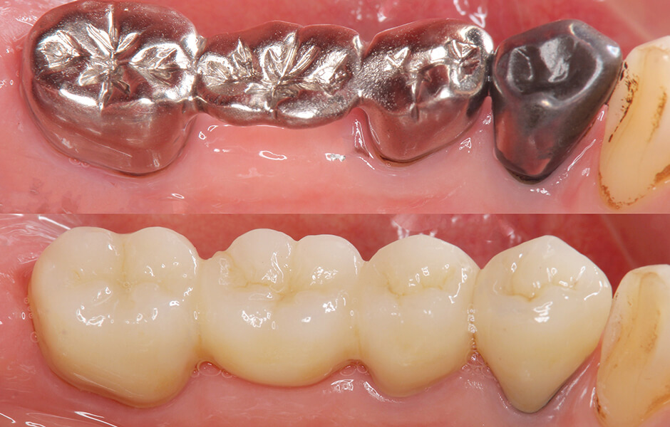 豊田市（若林）の歯医者、太田歯科医院のブリッジ治療