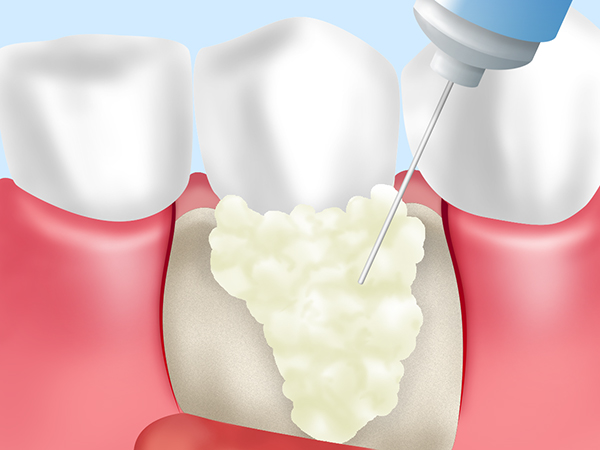 豊田市（若林）の歯医者、太田歯科医院の歯周病治療