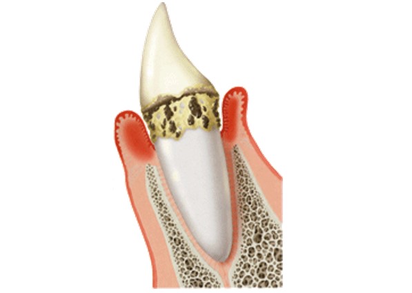 豊田市（若林）の歯医者、太田歯科医院の歯周病治療
