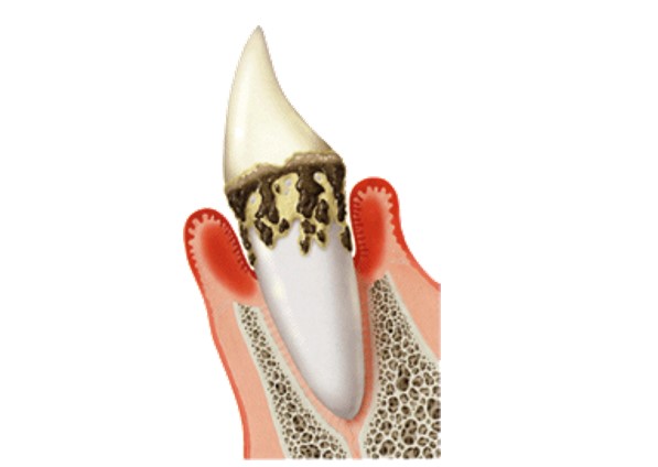 豊田市（若林）の歯医者、太田歯科医院の歯周病治療